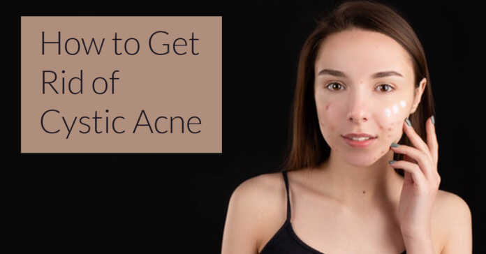 How to Get Rid of Cystic Acne